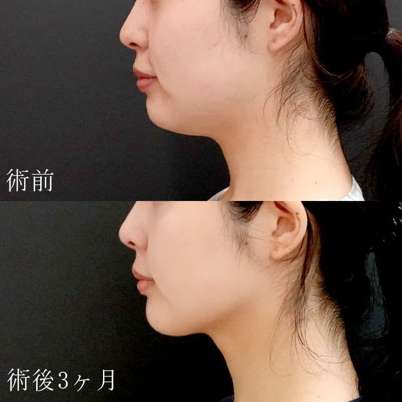 顔(頬+顎下)の脂肪吸引の症例写真