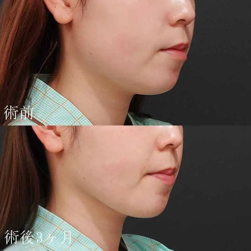 顔(頬＋顎下)の脂肪吸引の症例写真
