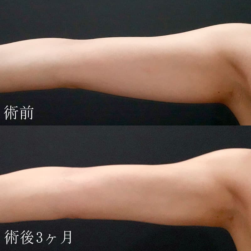二の腕の脂肪吸引の症例写真
