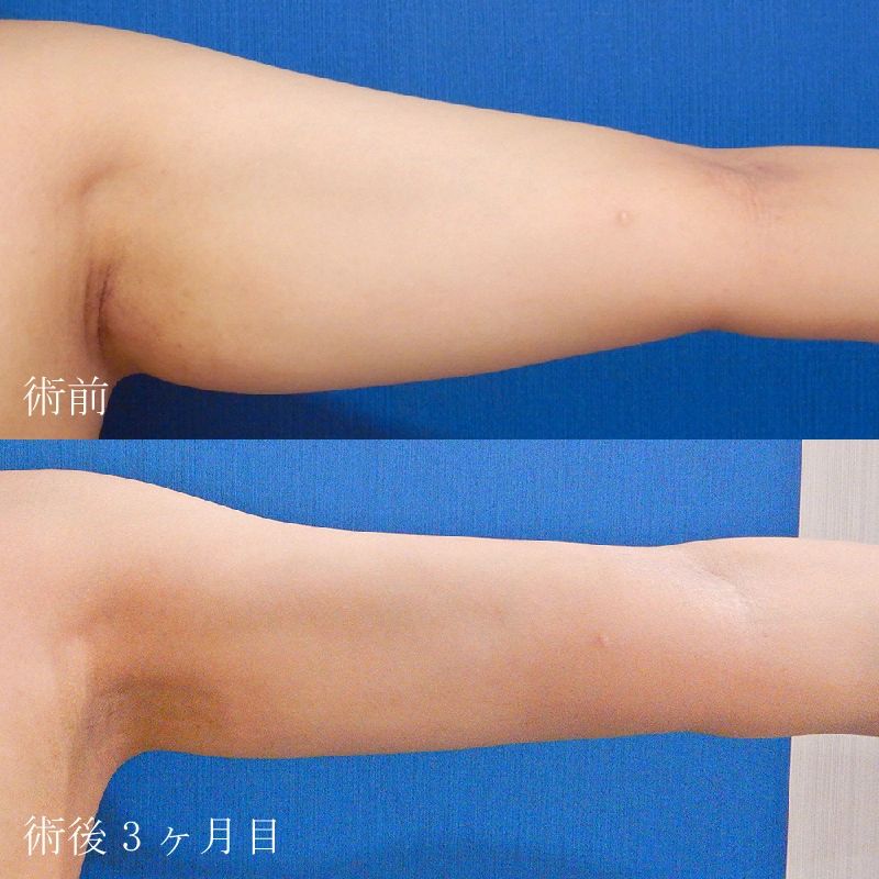 二の腕の脂肪吸引の症例写真