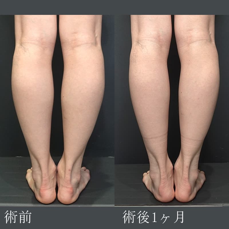 ふくらはぎのボトックスの症例写真