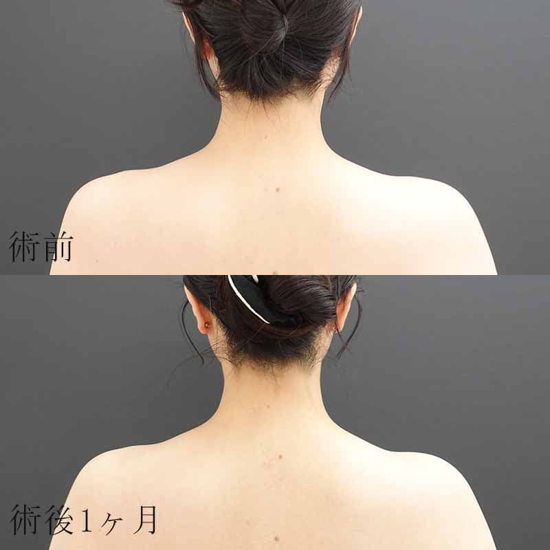 肩のボトックス注射の脂肪吸引の症例写真