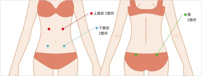 お腹・ウエスト・腰の脂肪吸引の吸引部位