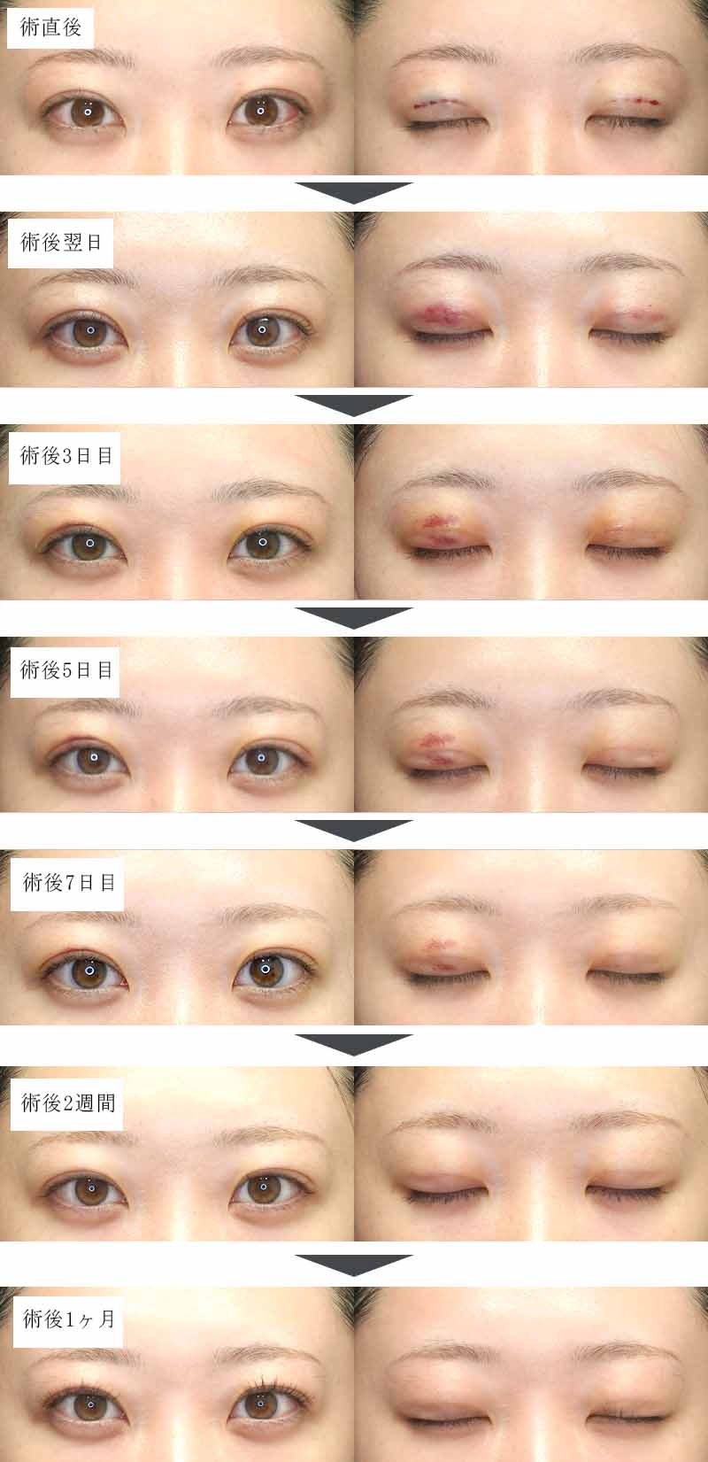 自然癒着法のダウンタイムの経過