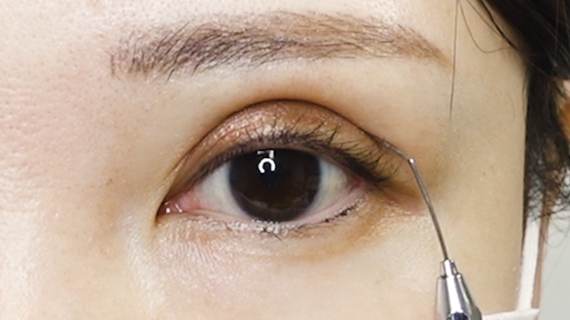 蒙古襞を確認しながら二重幅をシミュレーションする様子