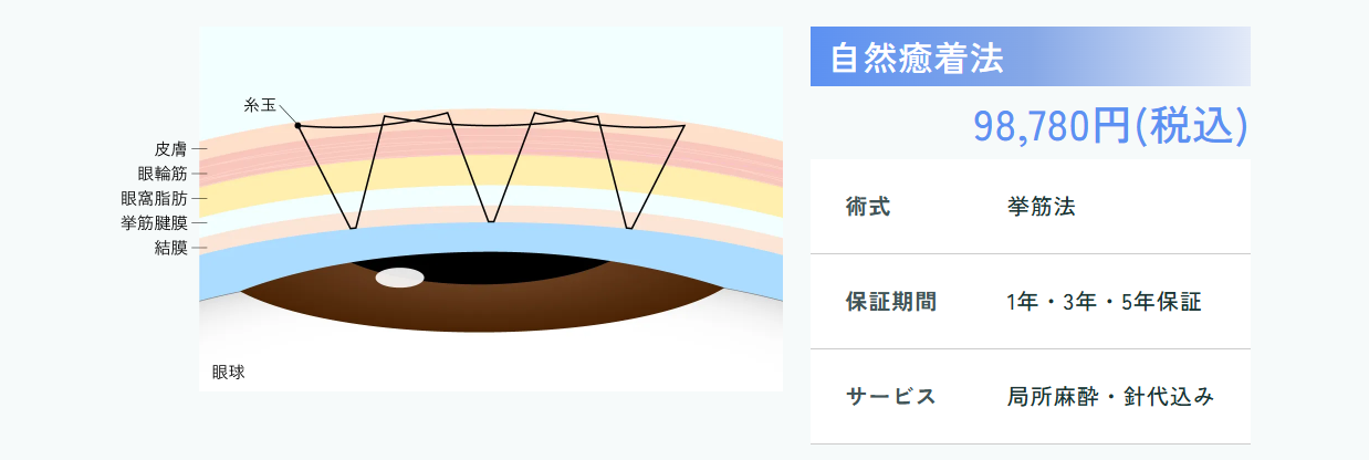 自然癒着法 98,780円(税込)／術式：挙筋法／保証期間：1年・3年・5年保証／サービス：局所麻酔・針代込み