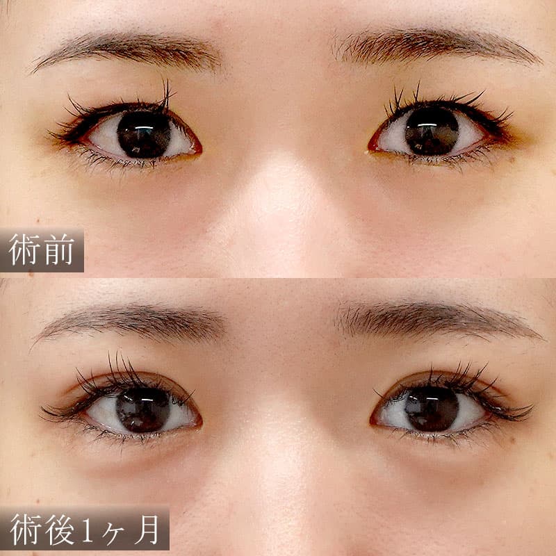 自然癒着法のセット症例写真