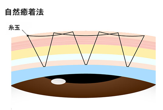 自然癒着法の糸の通し方