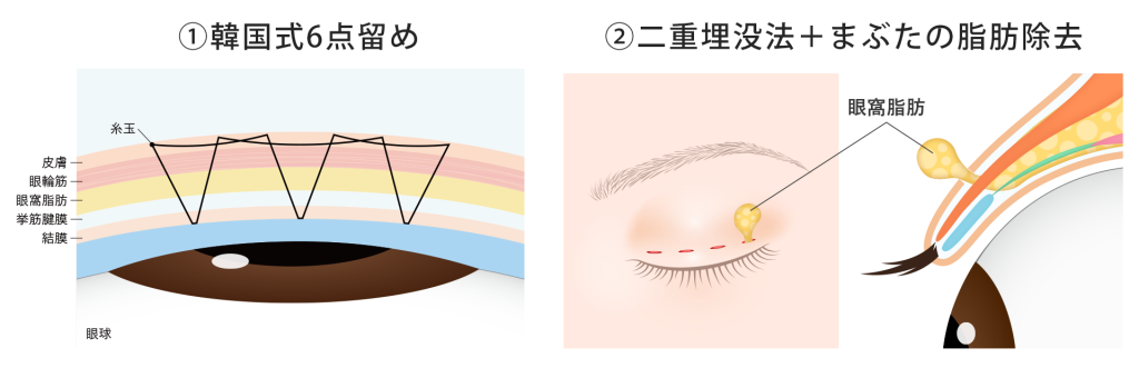 自然癒着法の種類